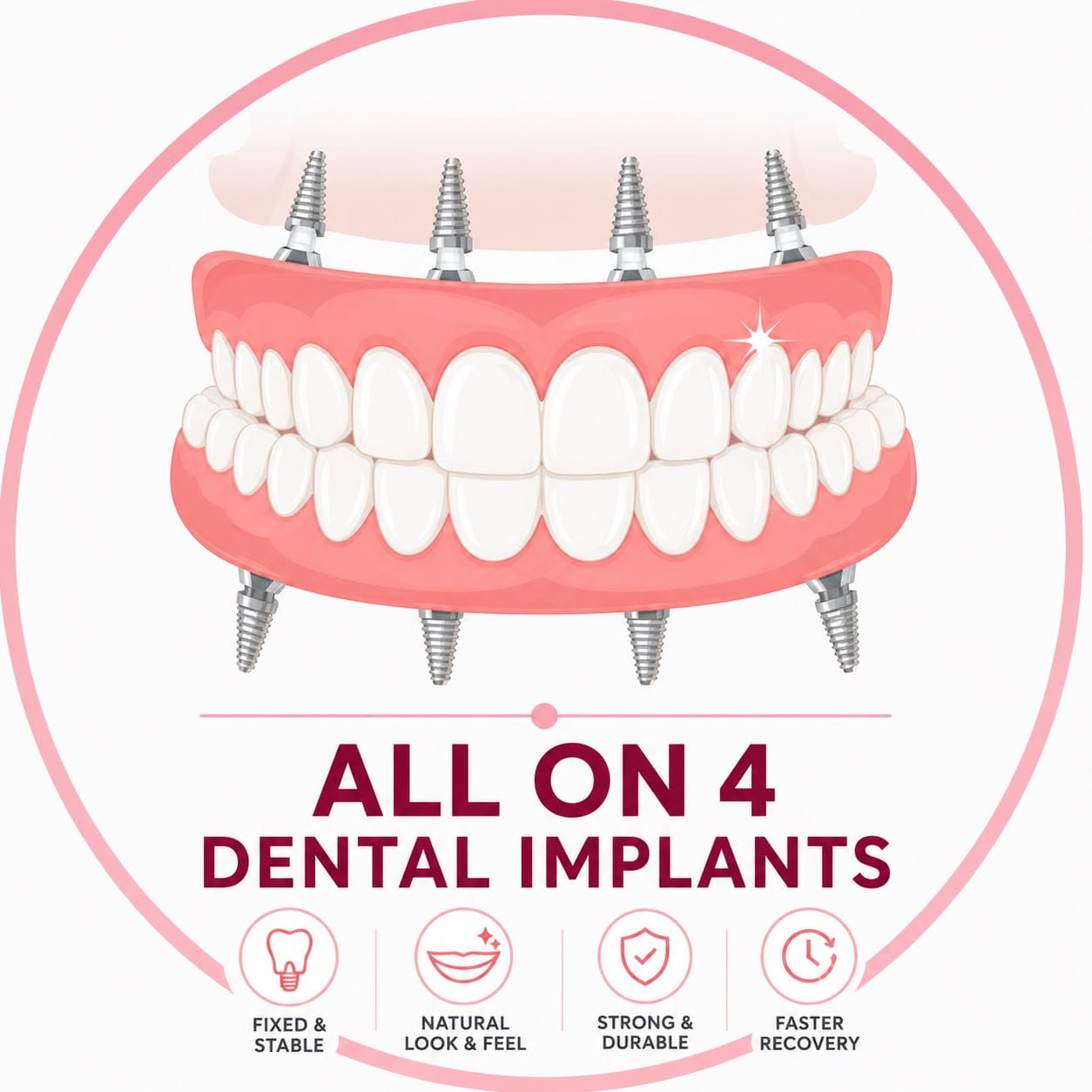 All-on-4 Dental Implants