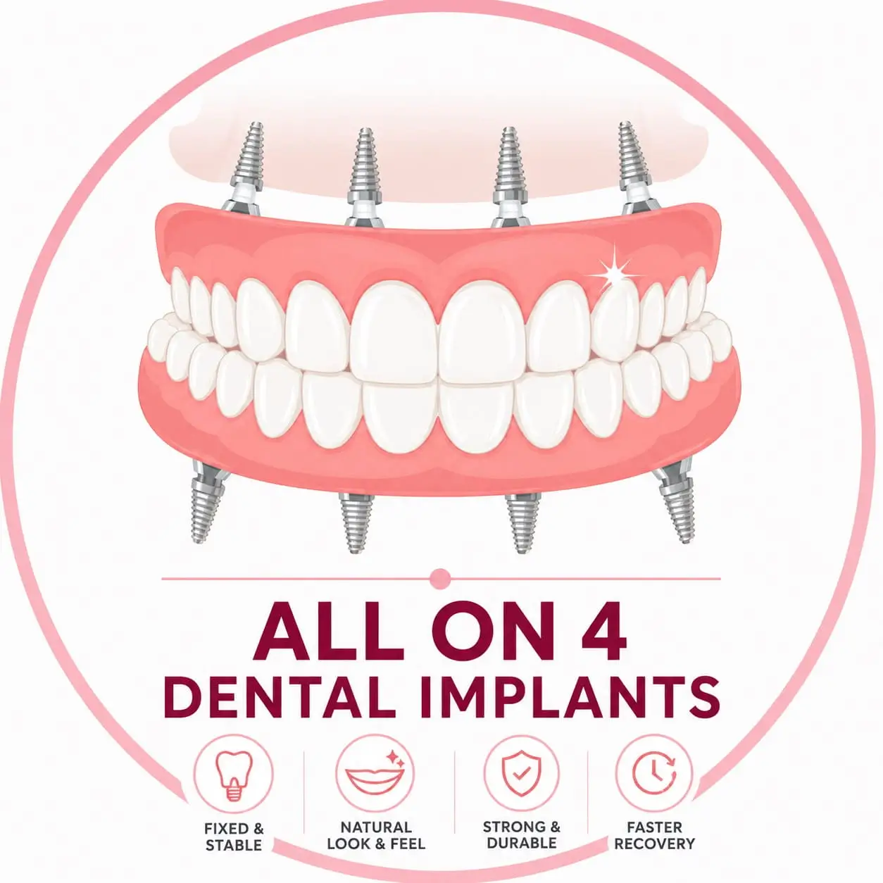 All-on-4 Dental Implants