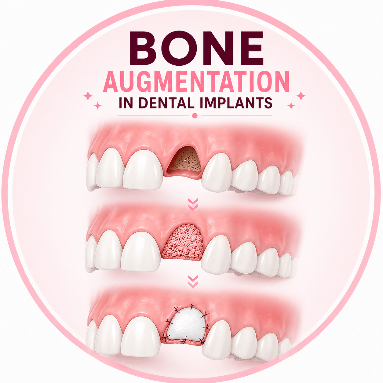 Bone Augmentation