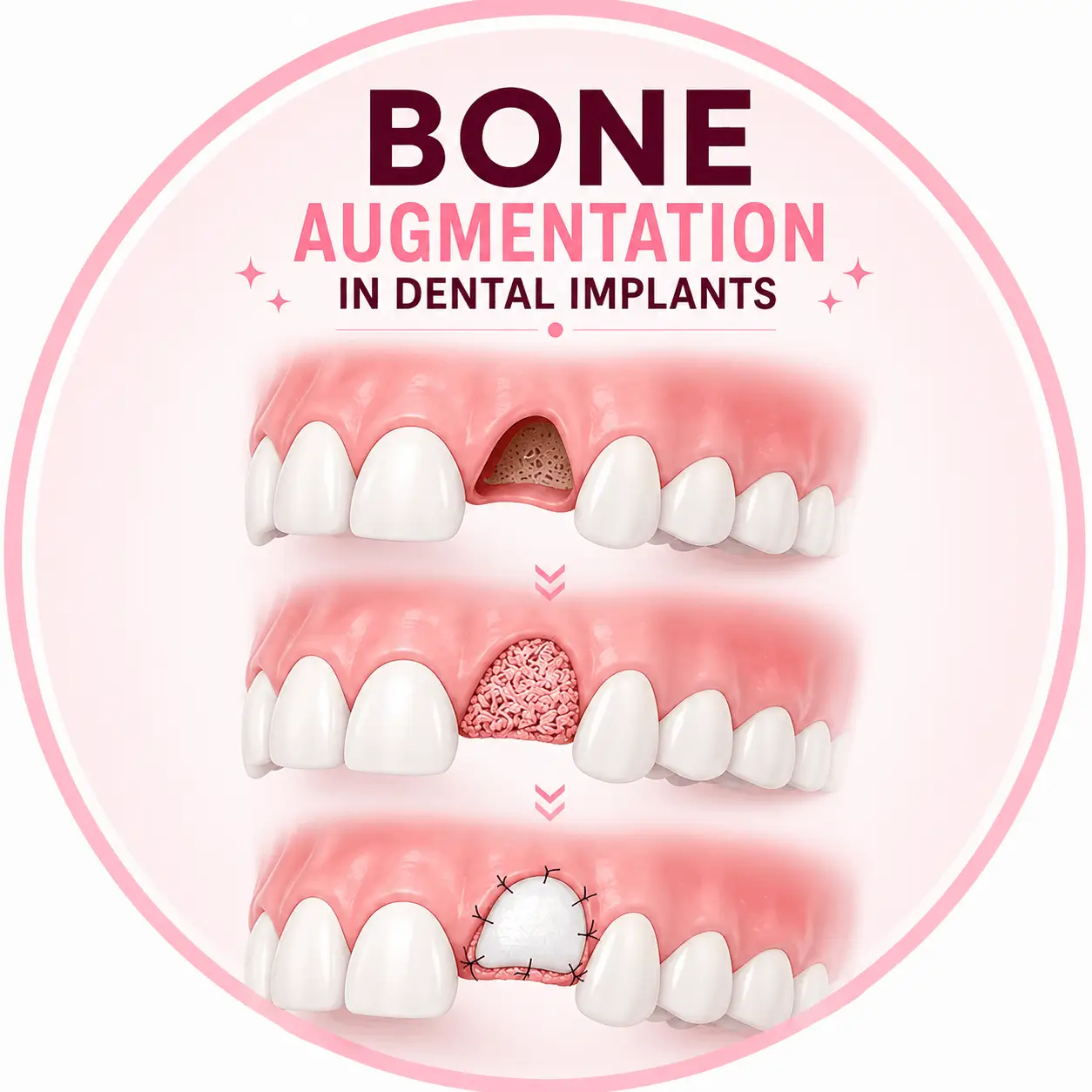 Bone Augmentation