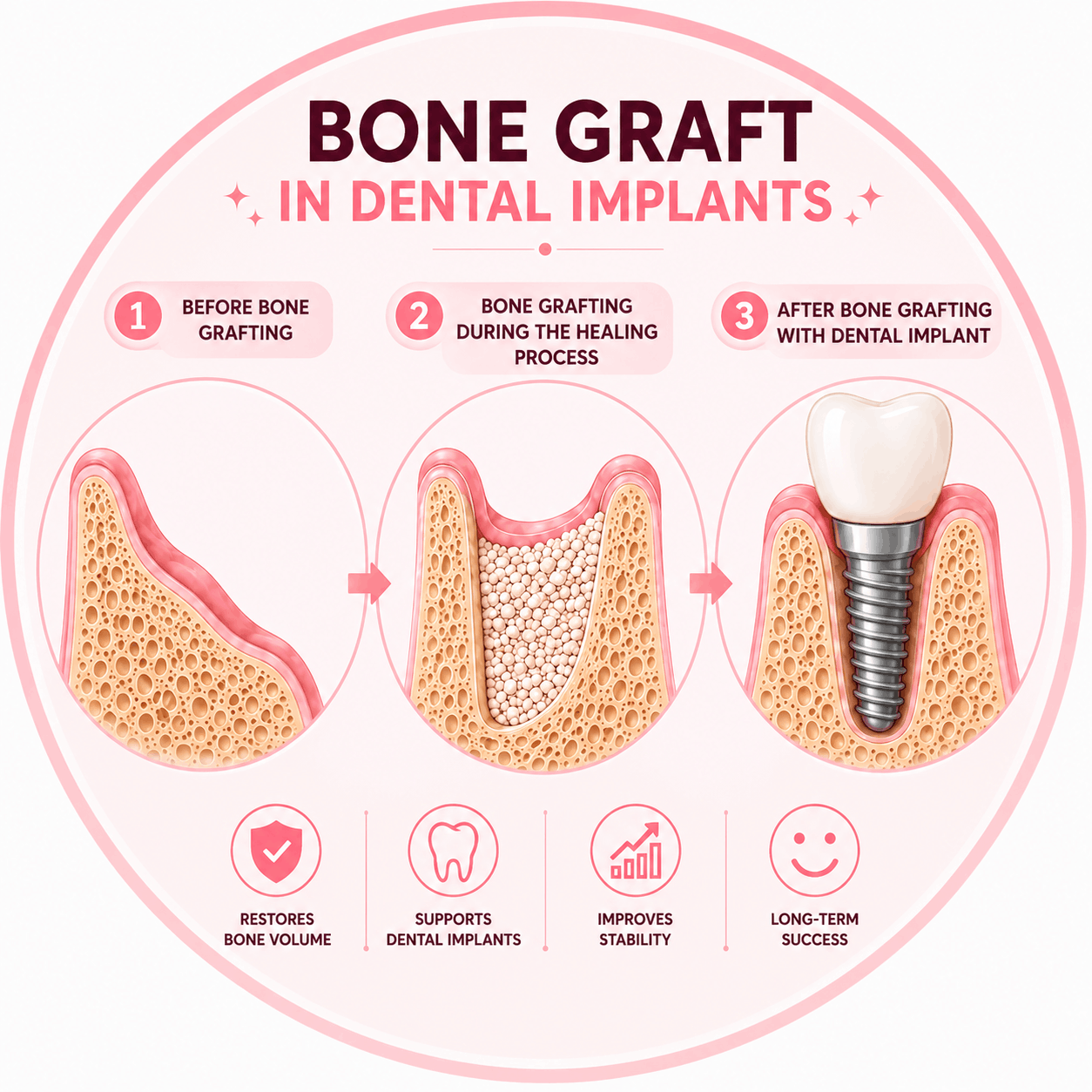 Bone Grafting