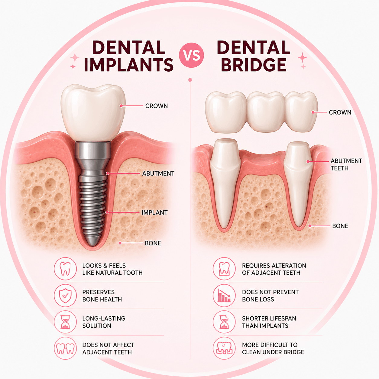 Implants vs Dental Bridge
