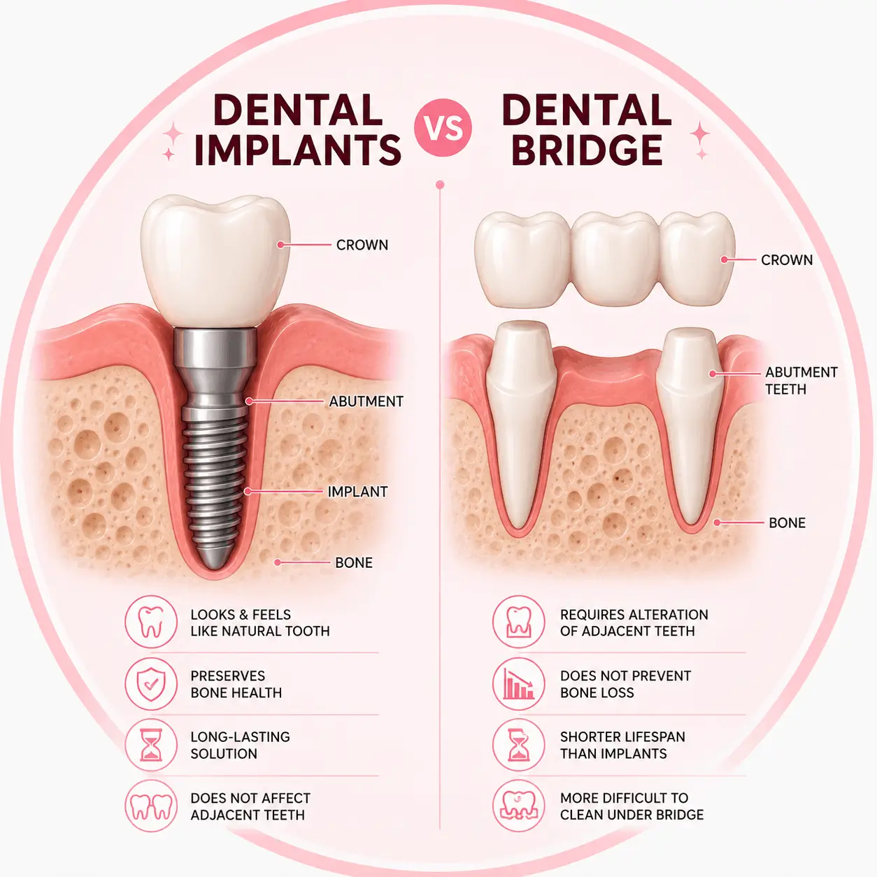 Implants vs Dental Bridge