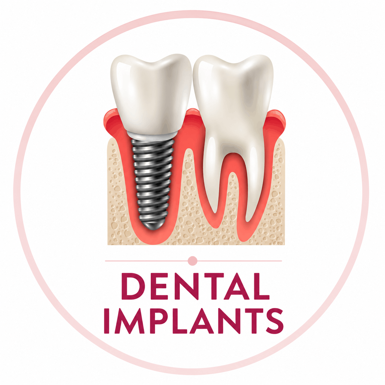 Dental Implants