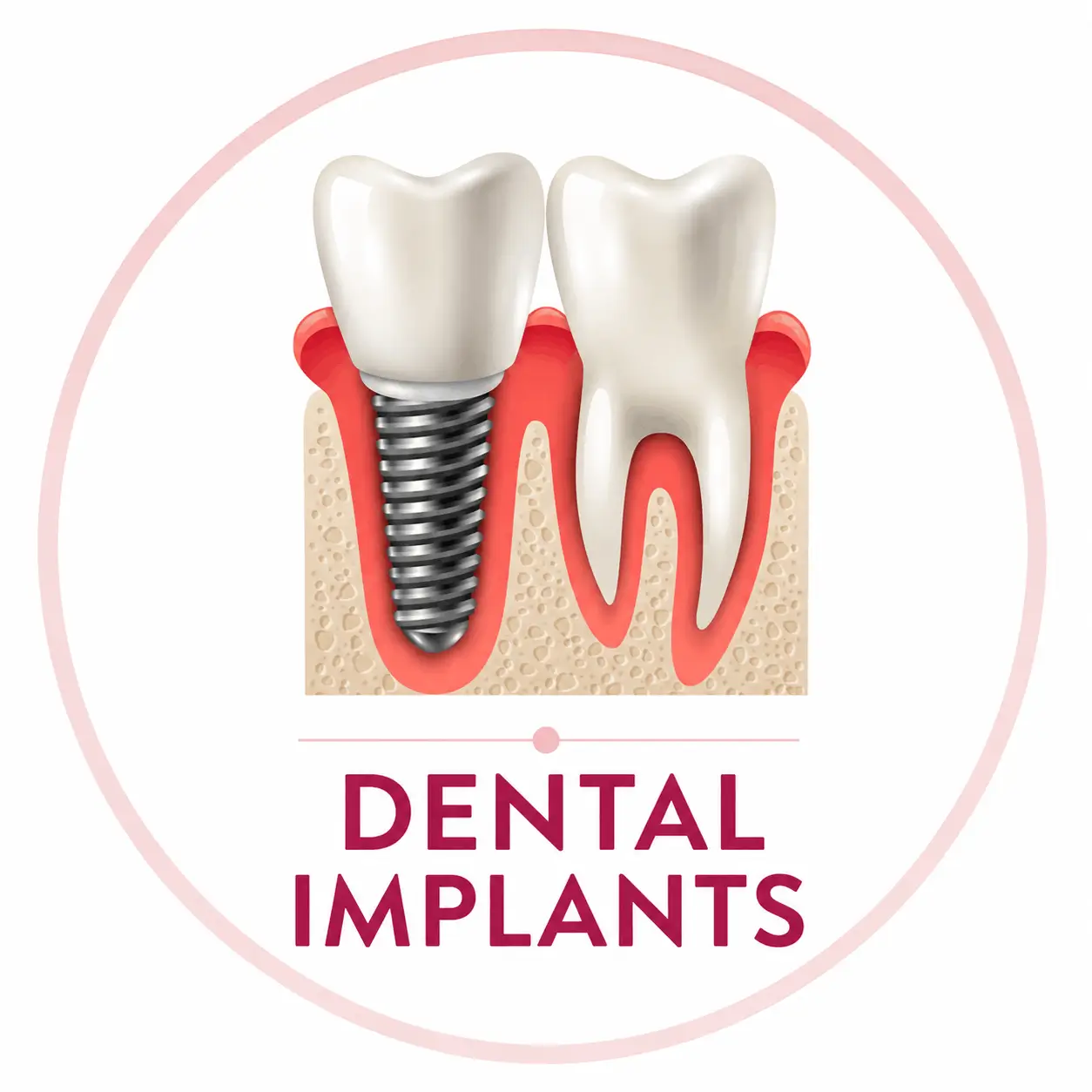 Dental Implants