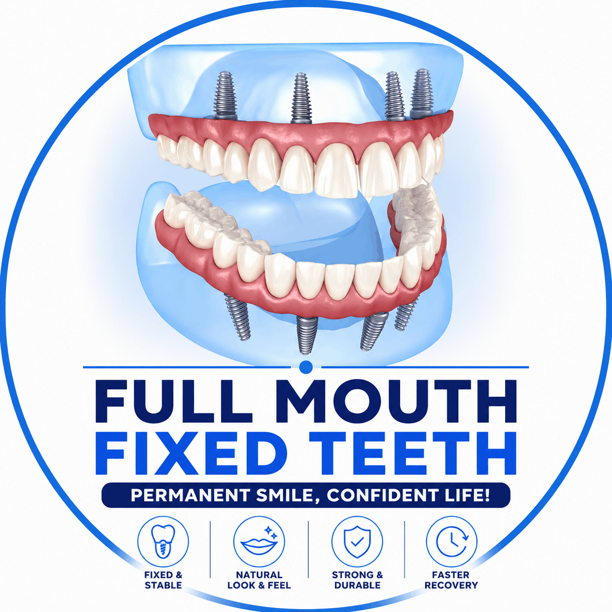 Full-Mouth Fixed Teeth