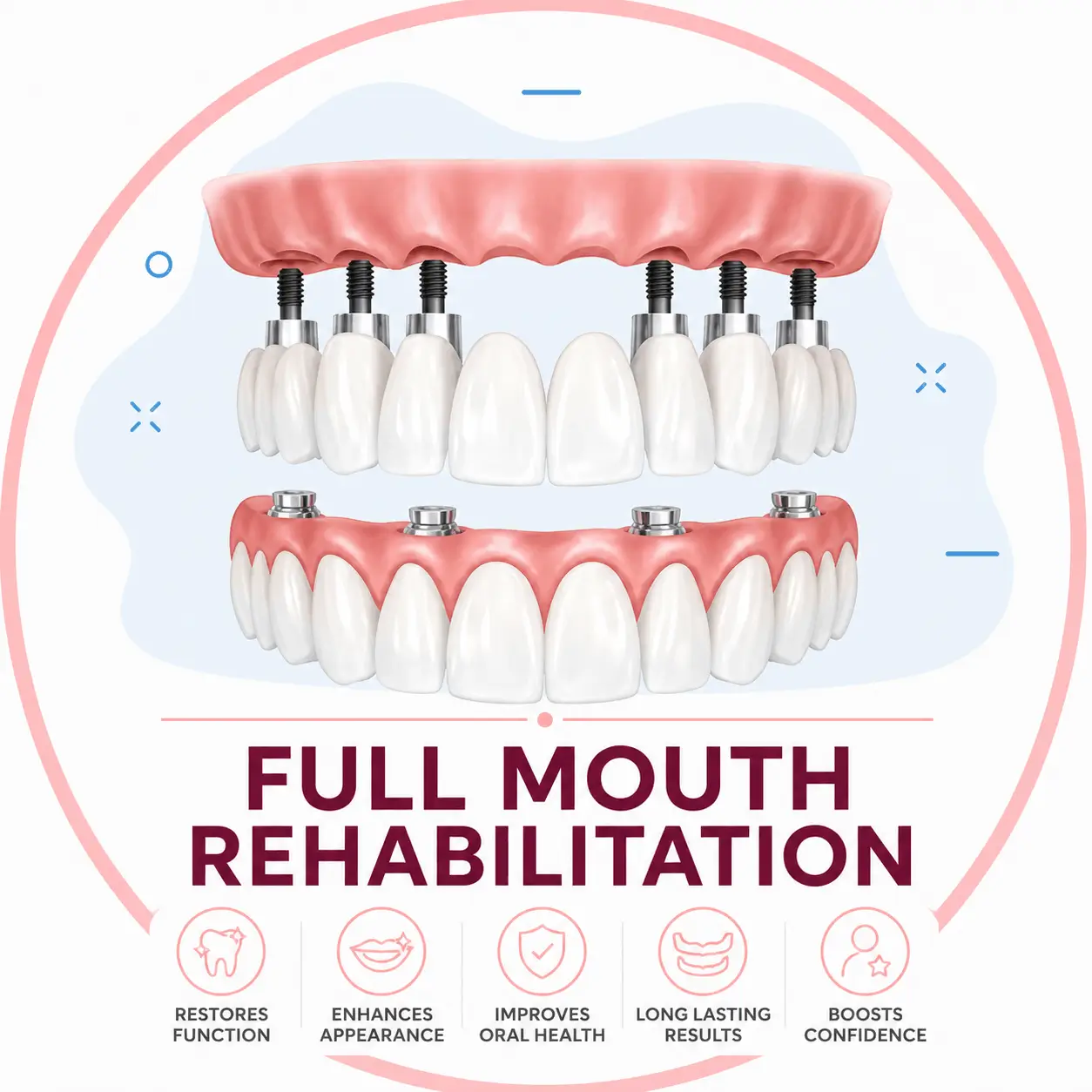 Full-Mouth Rehabilitation