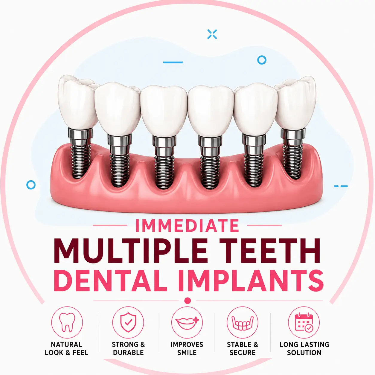 Immediate Multiple Teeth Replacement