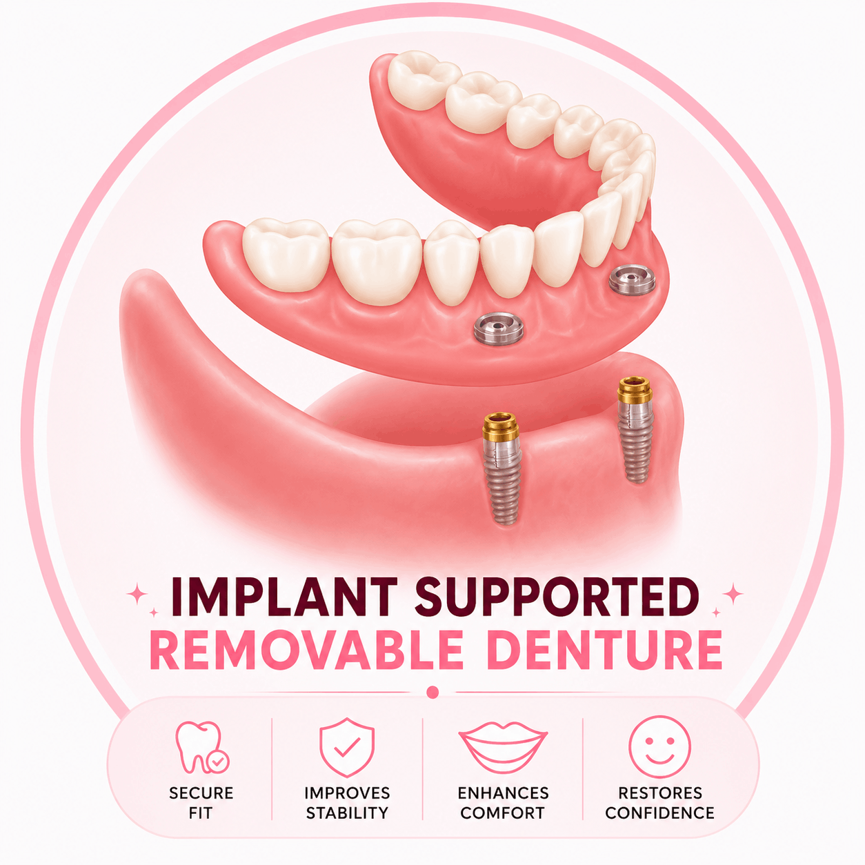 Implant-Supported Dentures