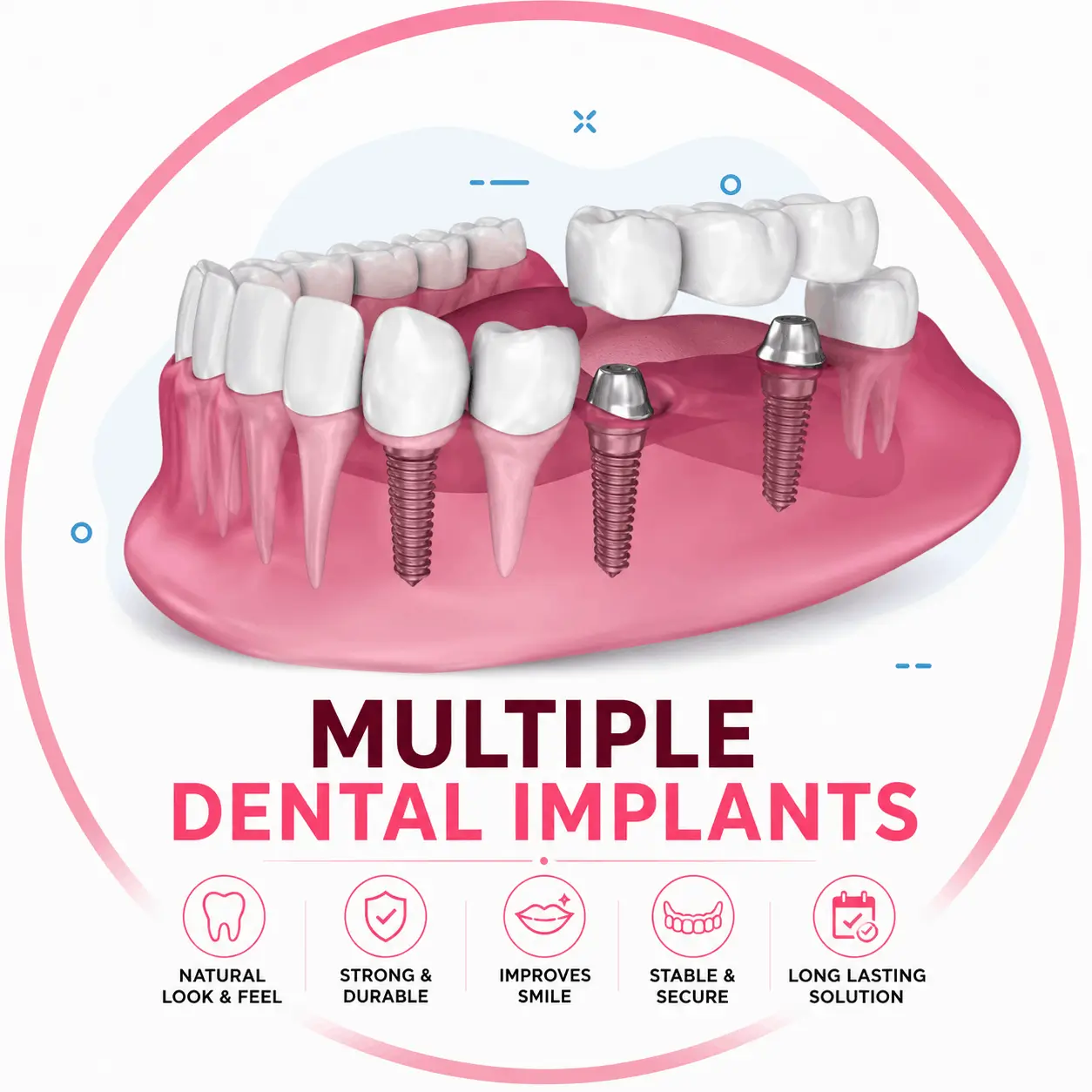 Multiple Teeth Replacement