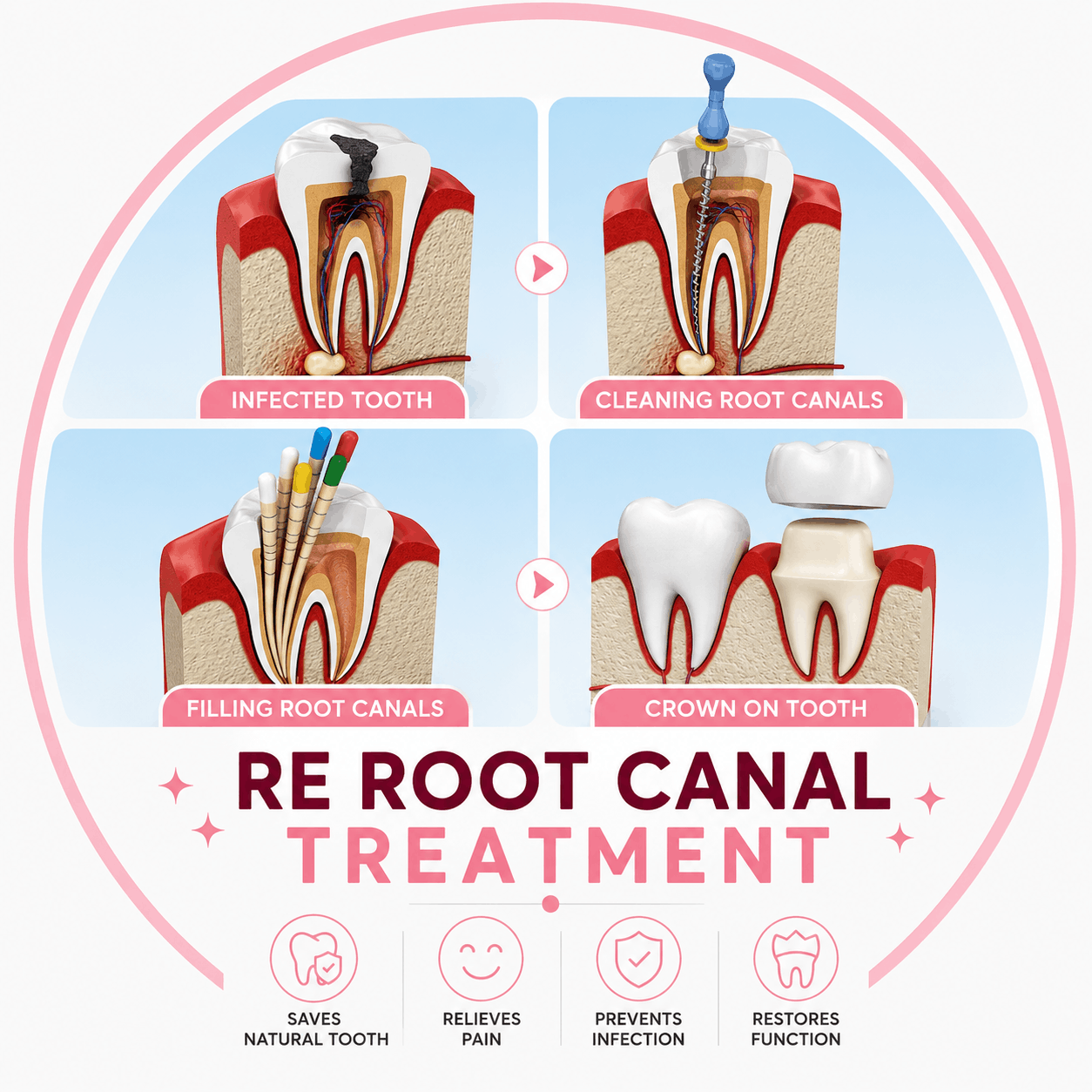 Re-Root Canal Treatment