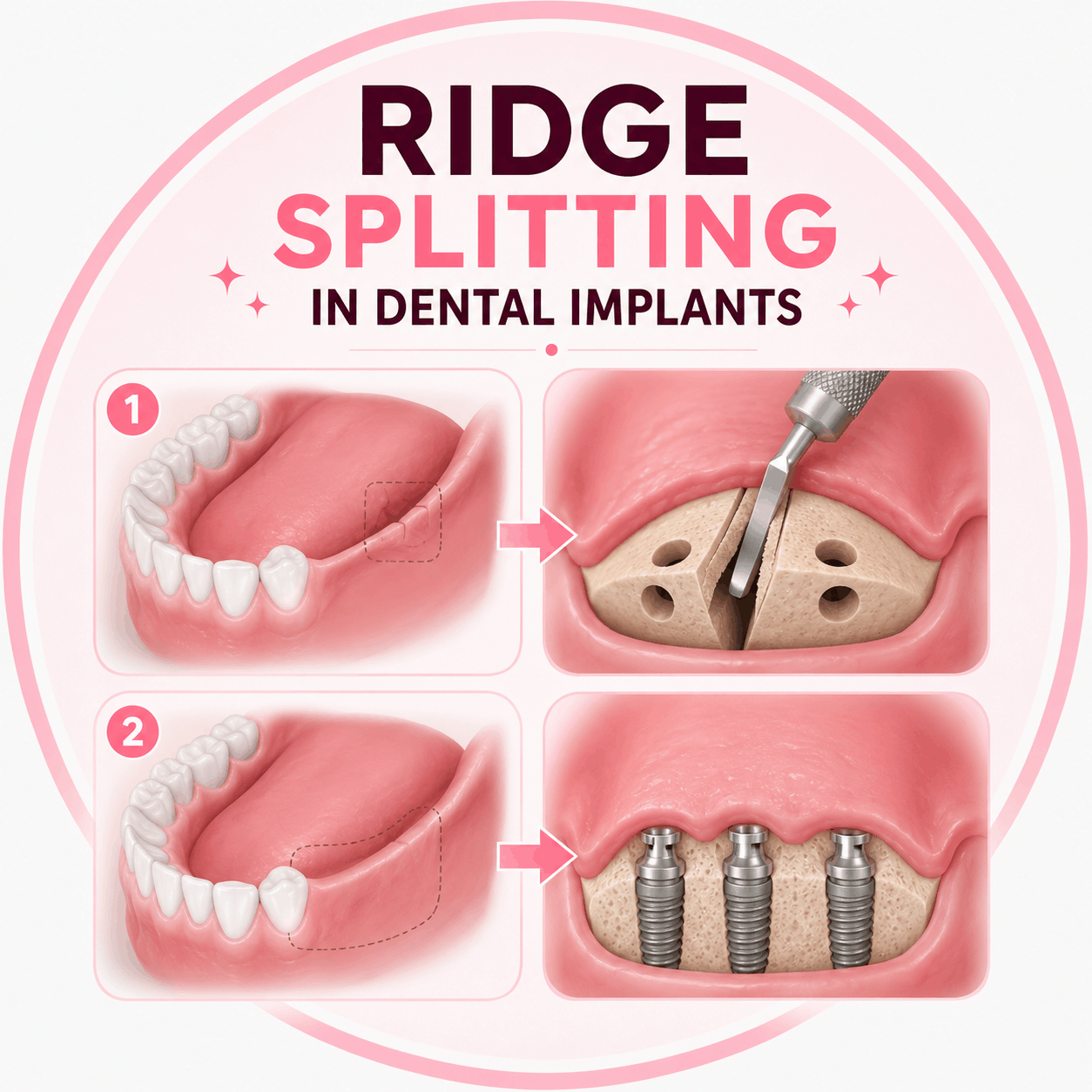 Bone Splitting