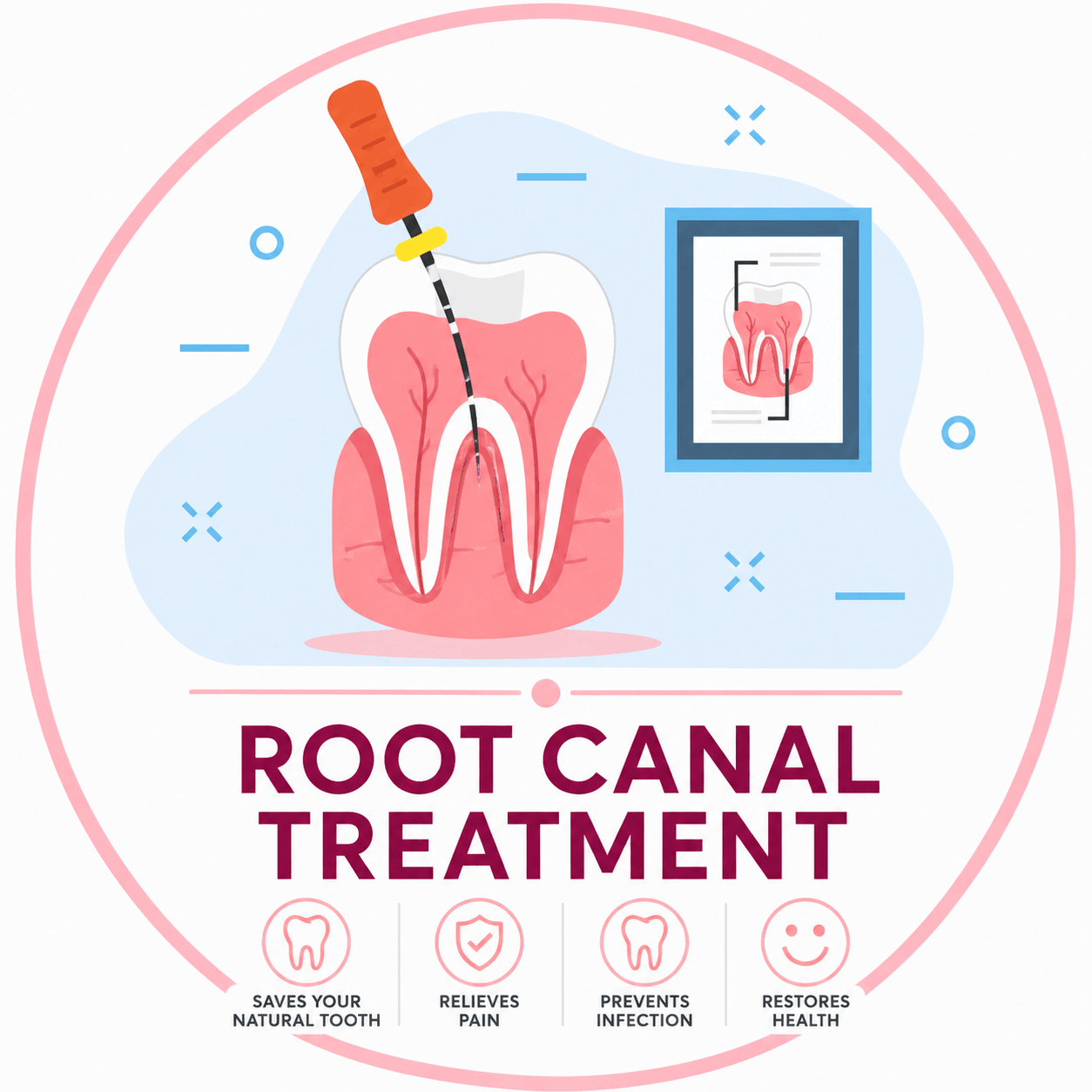 Root Canal Treatment