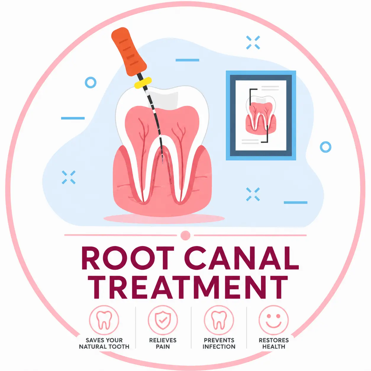Root Canal Treatment