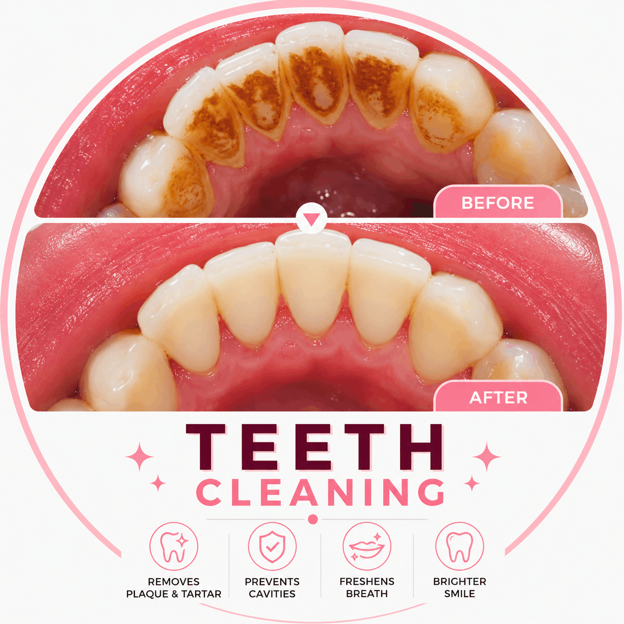 Teeth Cleaning