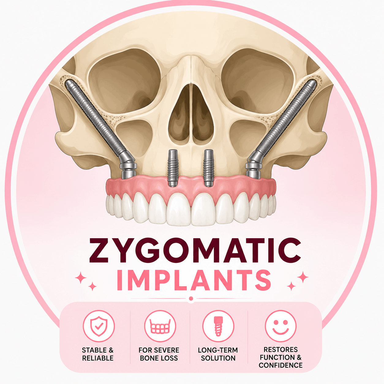 Zygomatic Implants