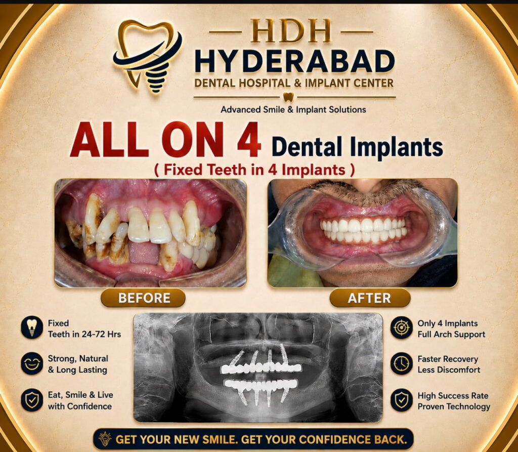 all-on-4-dental-implant