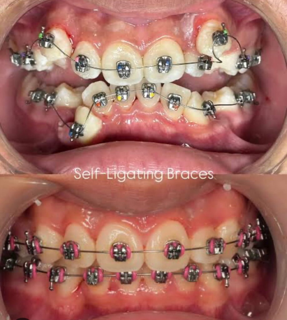 braces