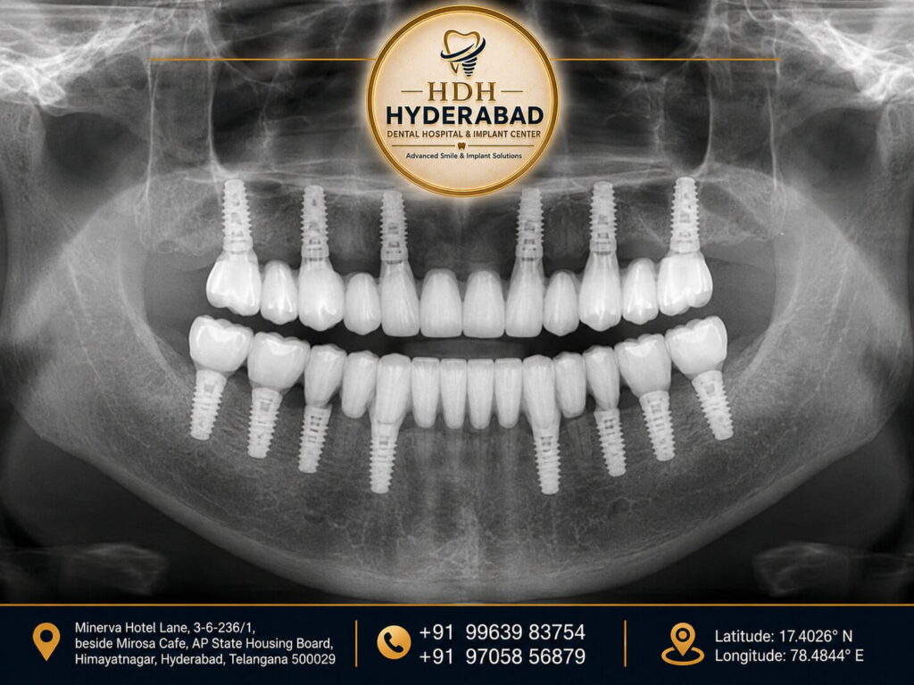dental-implant-1