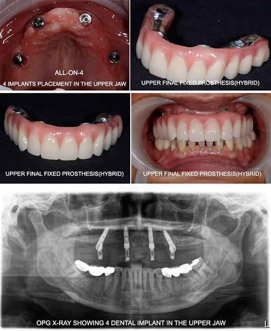 dental-implant-10