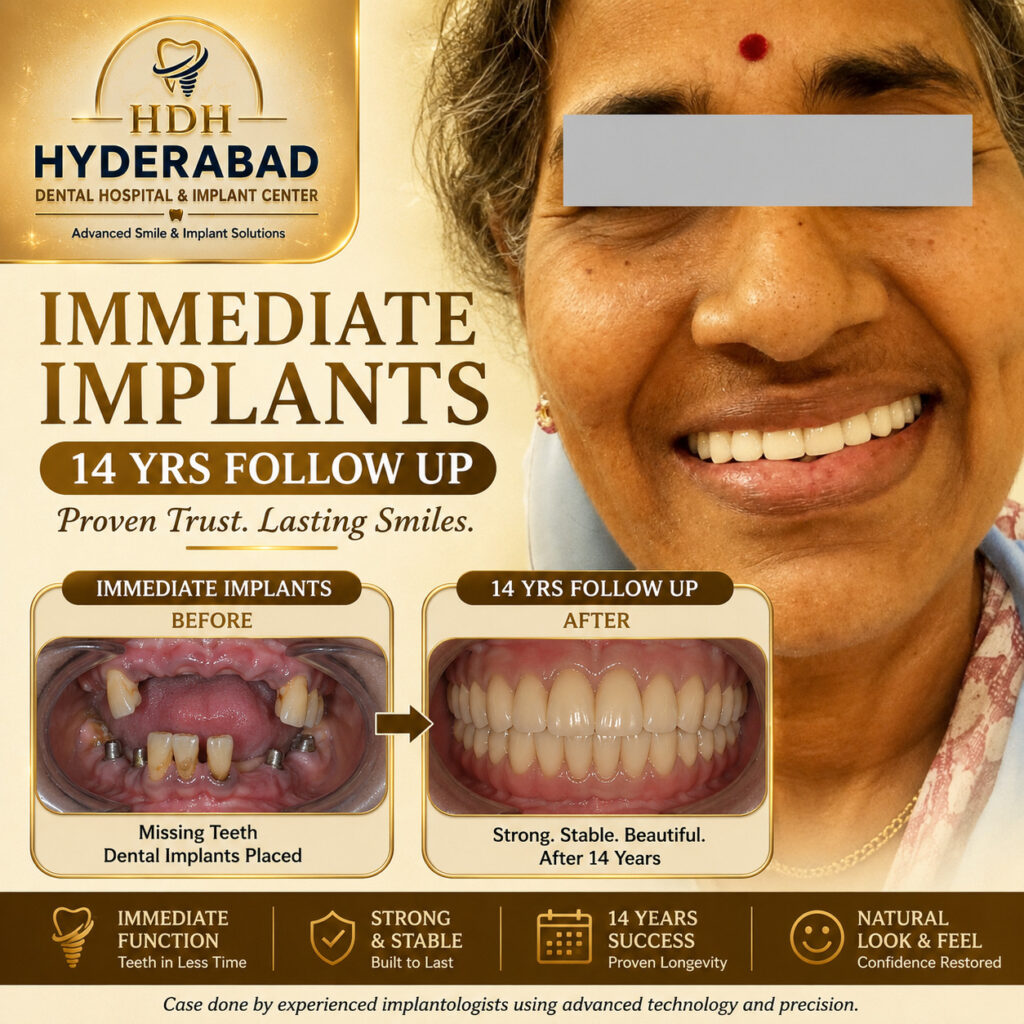 immediate-implants