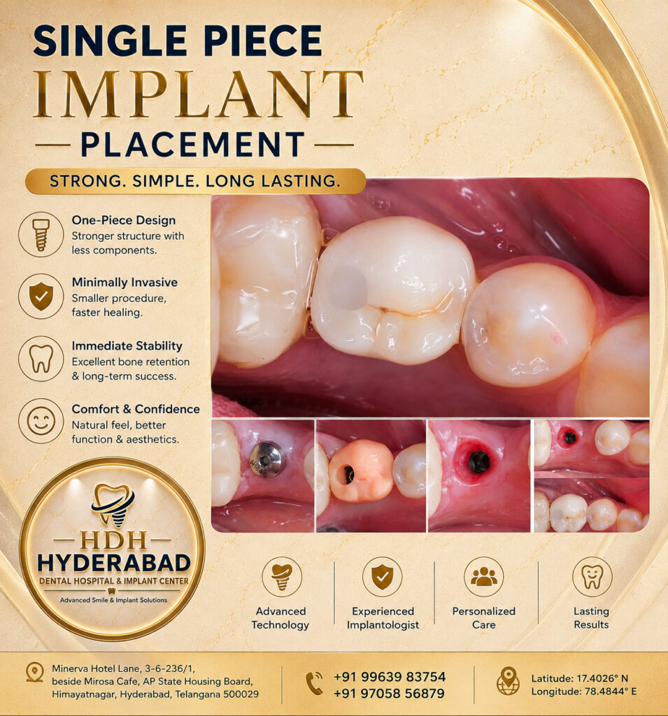 single-piece-implant-placement
