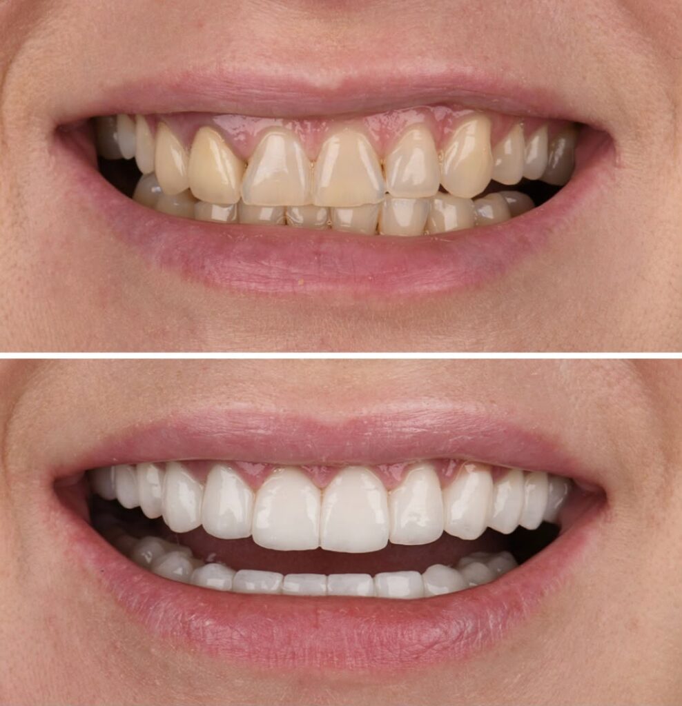 smile-makeover-3